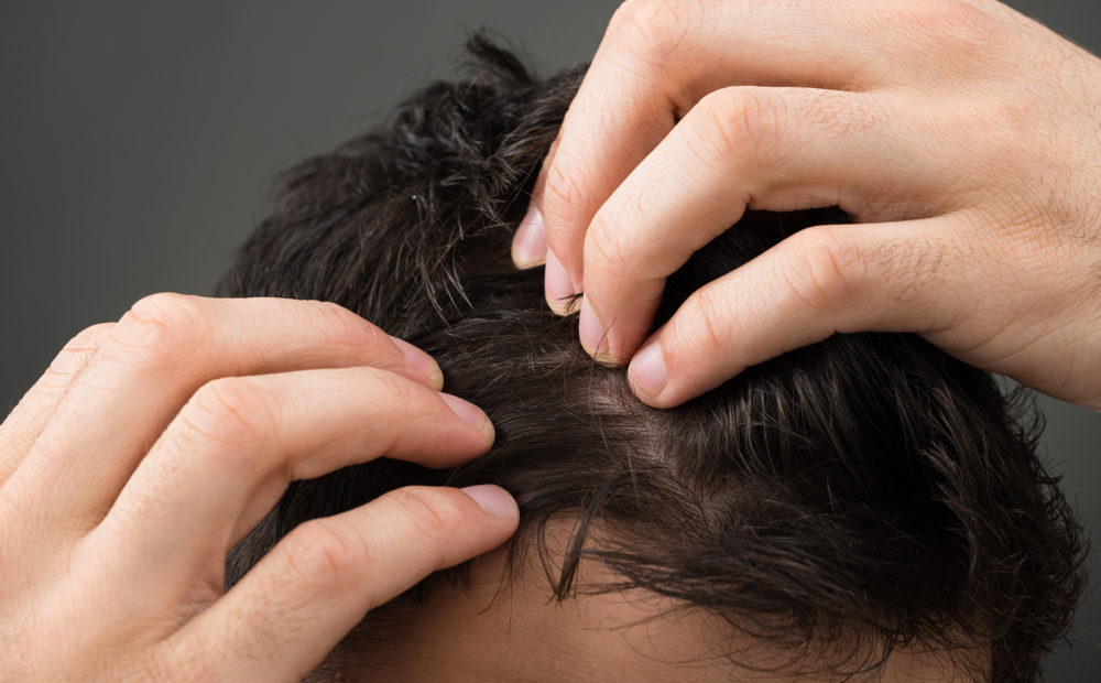 microimplante de pelo en cicatrices