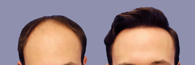 antes-y-despues-del-injerto-de-pelo-en-turquia-01