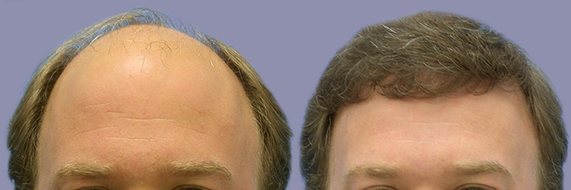 antes-y-despues-del-injerto-de-pelo-en-turquia-03