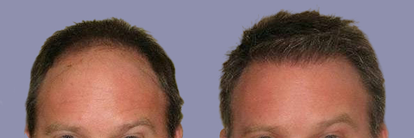 antes-y-despues-del-injerto-de-pelo-en-turquia-04