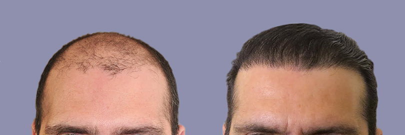 antes-y-despues-del-injerto-de-pelo-en-turquia-05