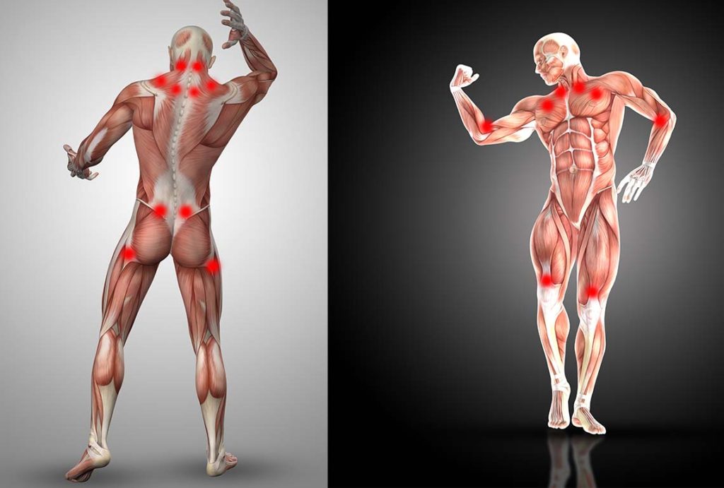 Puntos gatillo o puntos de dolor en la fibromialgia.