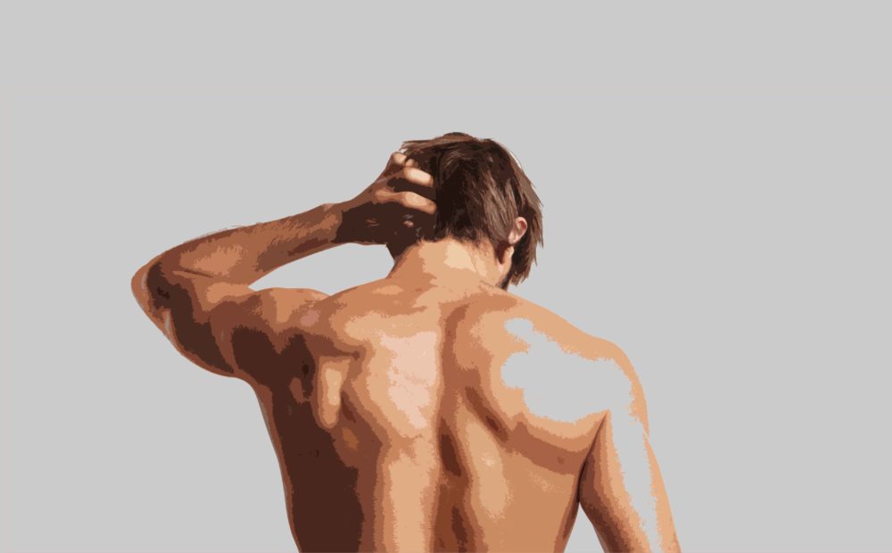 cicatrices tras un injerto capilar