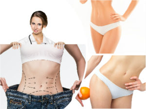 Normalmente, los resultados que se alcanzan con la liposucción son muy satisfactorios para sus pacientes.