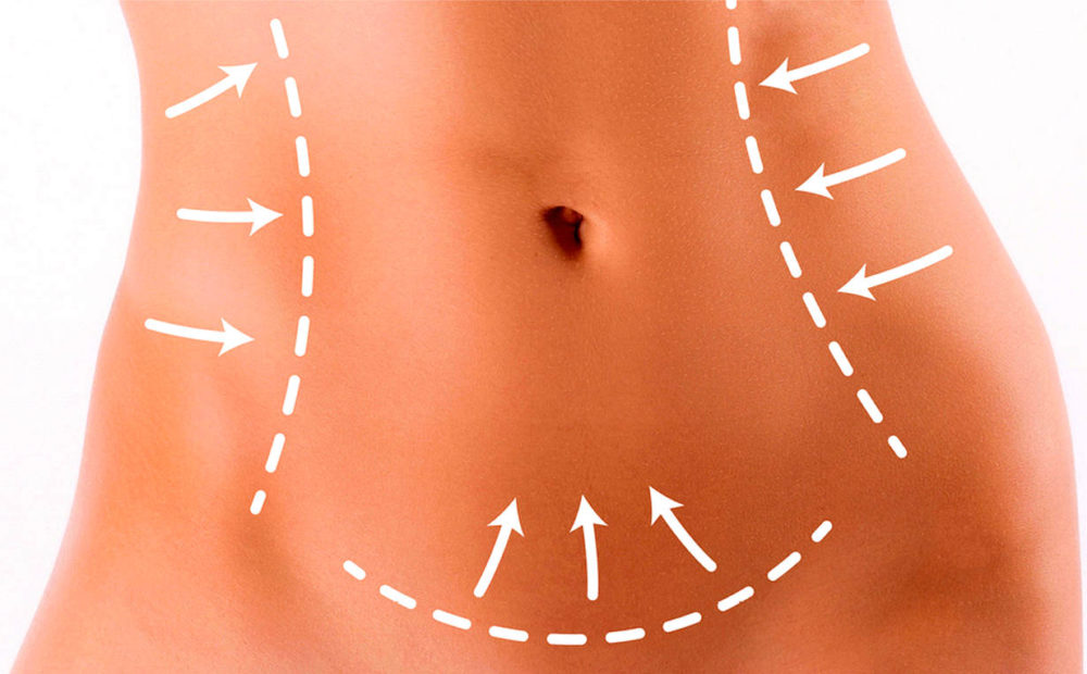 Consejos básicos para una liposucción