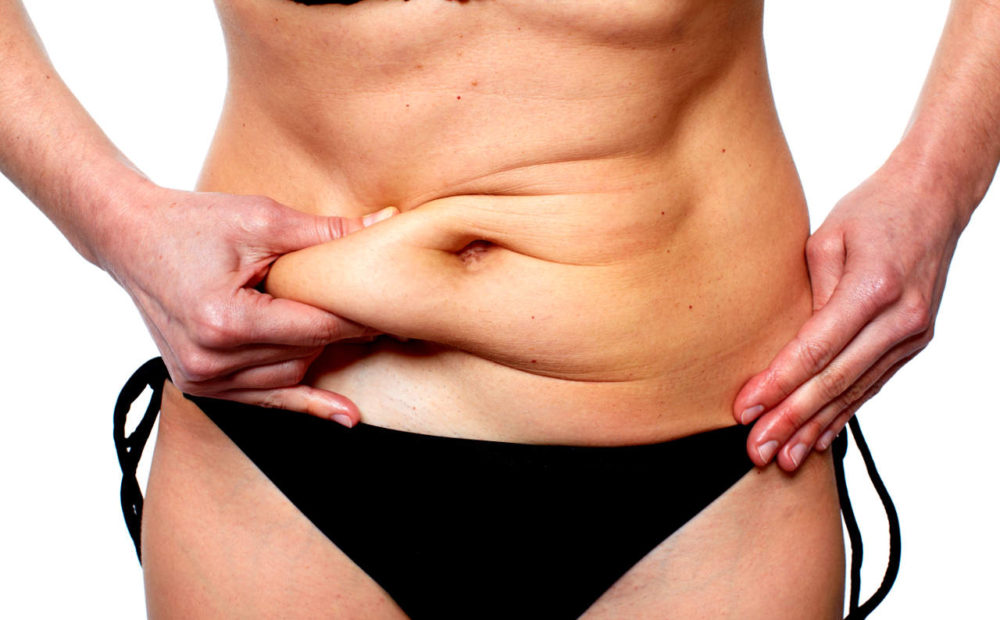 Liposucción con obesidad