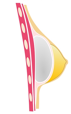 Colocación de implante subfascial