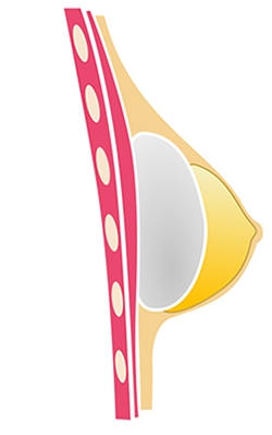 Colocación de implante subglandular