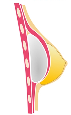 Colocación de implante submuscular