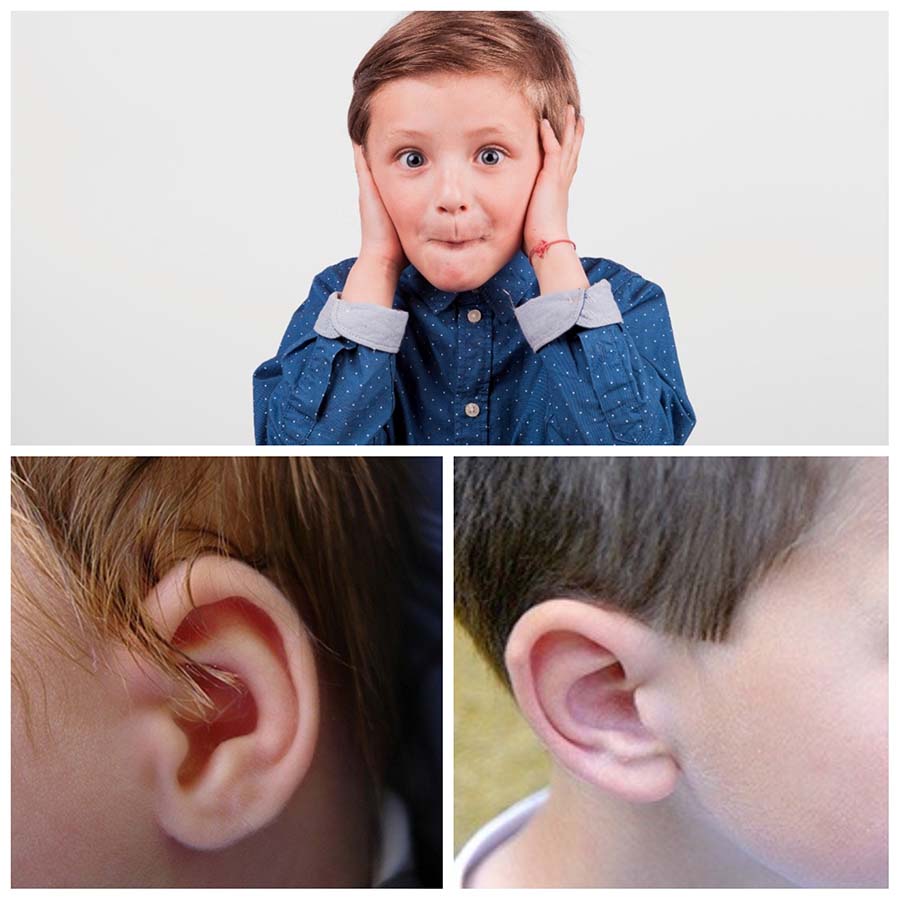 La otoplastia en Madrid es una de las intervenciones estéticas más realizadas en niños.