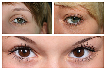 La blefaroplastia en Sevilla se puede realizar en el párpado inferior, en el superior o en ambos