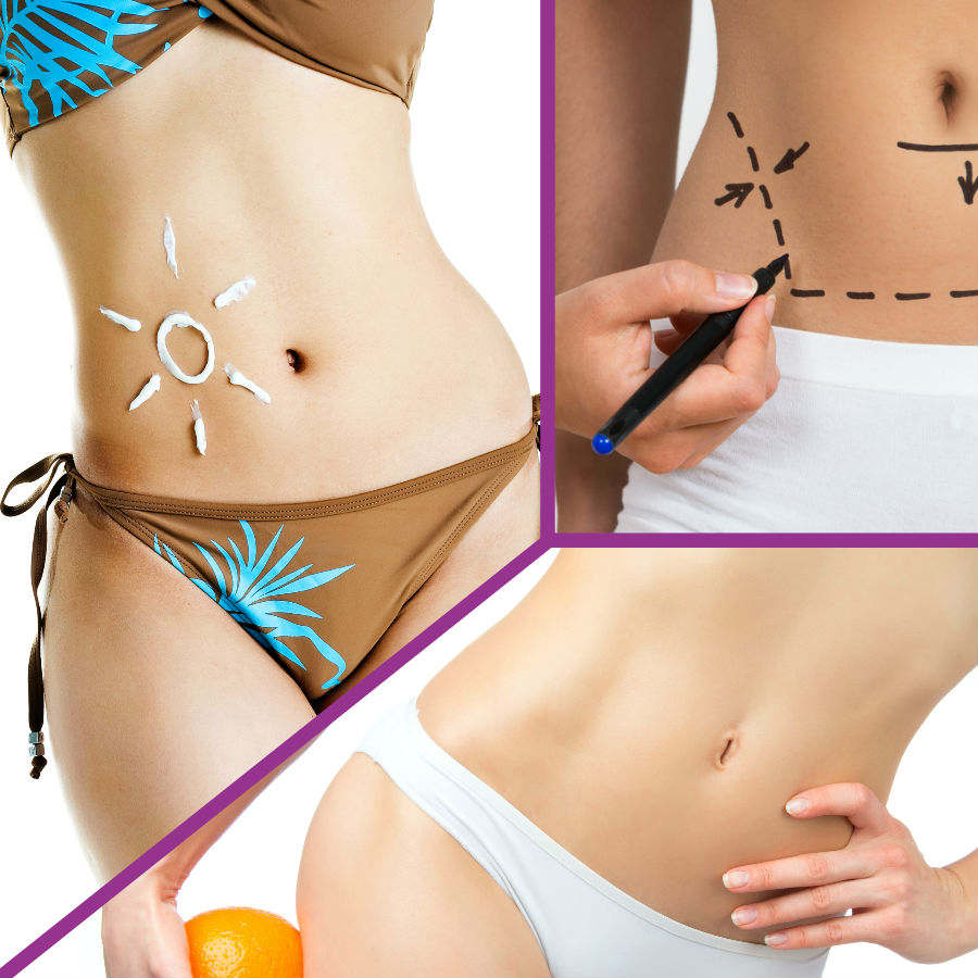 Una de las desventajas de la abdominoplastia en Cádiz es la cicatriz, aunque esto no tiene porque suponer un problema.