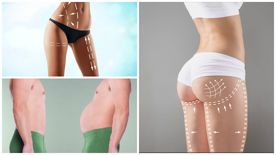 El postoperatorio de la liposucción en Tenerife puede ocasionar molestias leves, pero no tiene complicaciones mayores.