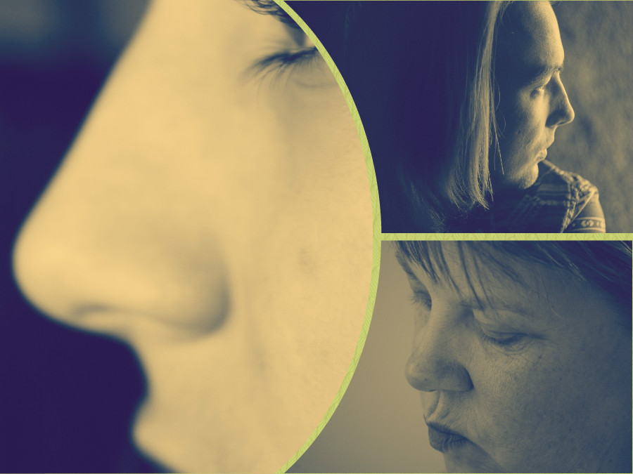 En una rinoplastia en Oviedo puede emplearse anestesia general o local con sedación.