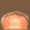 Injerto de pelo en Turquía imagen 2